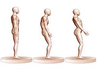 hipercifosis e hiperlordosis de la columna vertebral