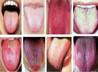 diagnostico por la lengua